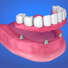 7 Advantages of Dental Implants Over Dentures