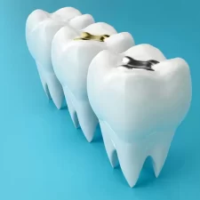 Finding the Right Dentist in Dublin for Dental Fillings