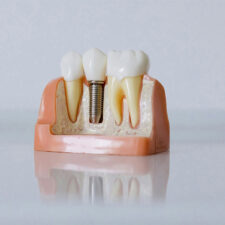 Can Smokers Get Dental Implants Successfully?